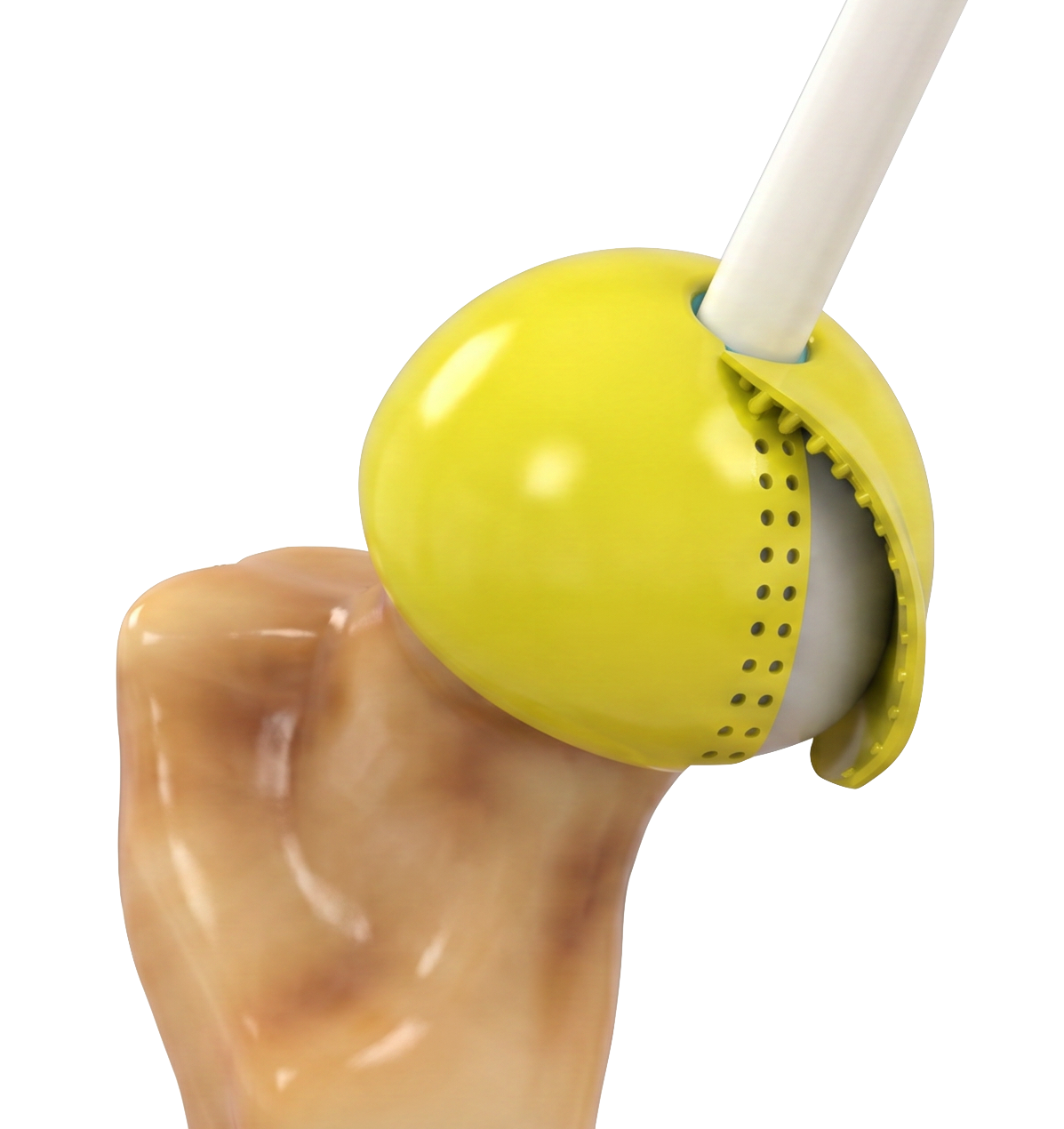 Concept rendering of a hip implant on a femoral head