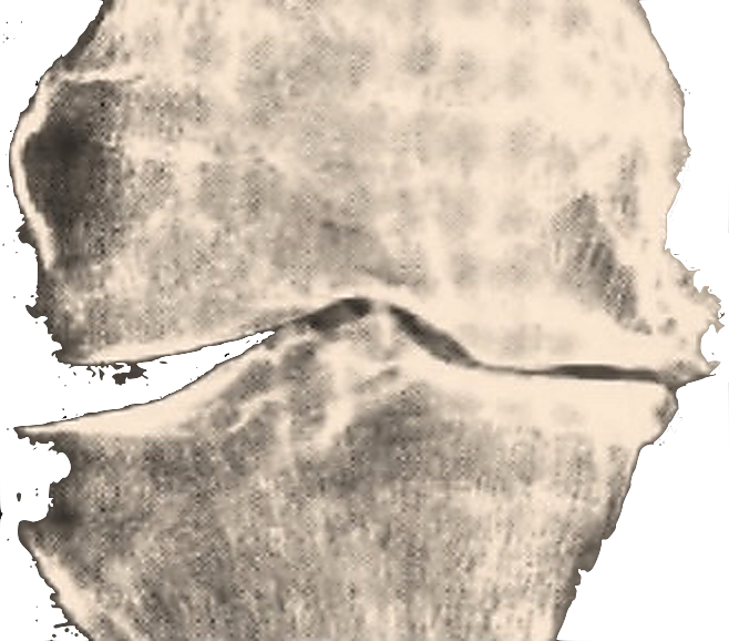 X-ray of a late-stage osteoarthritic knee